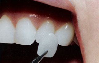COSMETIC SERVICES | Quality Dental Care