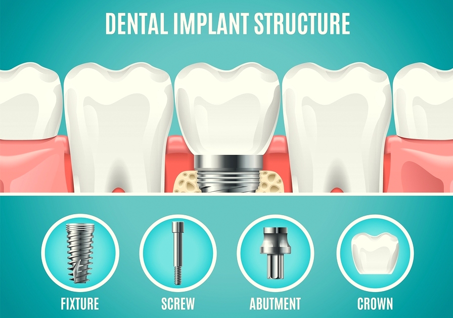 https://clone.qualitydentalcare.com.au/wp-content/uploads/2022/02/Dental-Implant-Brighton-Road4.jpg