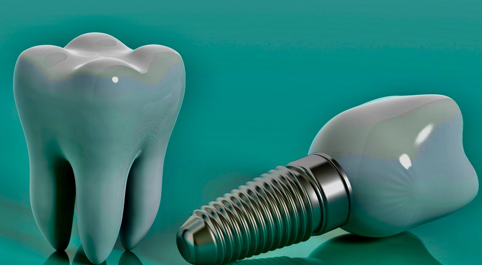 https://clone.qualitydentalcare.com.au/wp-content/uploads/2022/02/qdc-13-1-1.jpeg