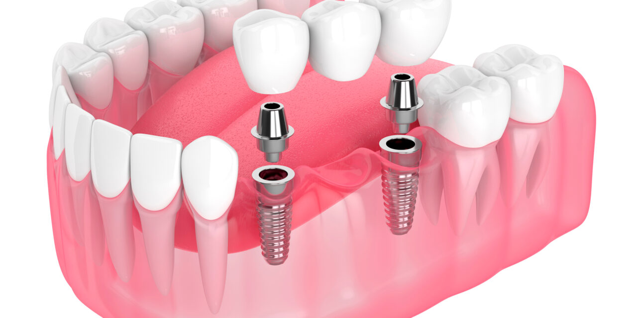 https://clone.qualitydentalcare.com.au/wp-content/uploads/2022/03/38386533b7c34f6b9dabc2258b2af172-1-1280x640.jpeg