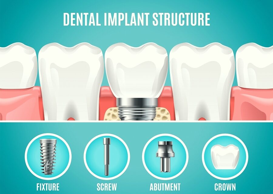 https://clone.qualitydentalcare.com.au/wp-content/uploads/2022/03/type-of-dental-implants-1-900x640.jpg